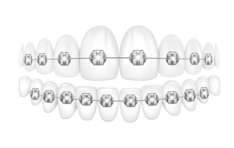 Лигатурная брекет-система «American Orthodontics» Mini Master Series